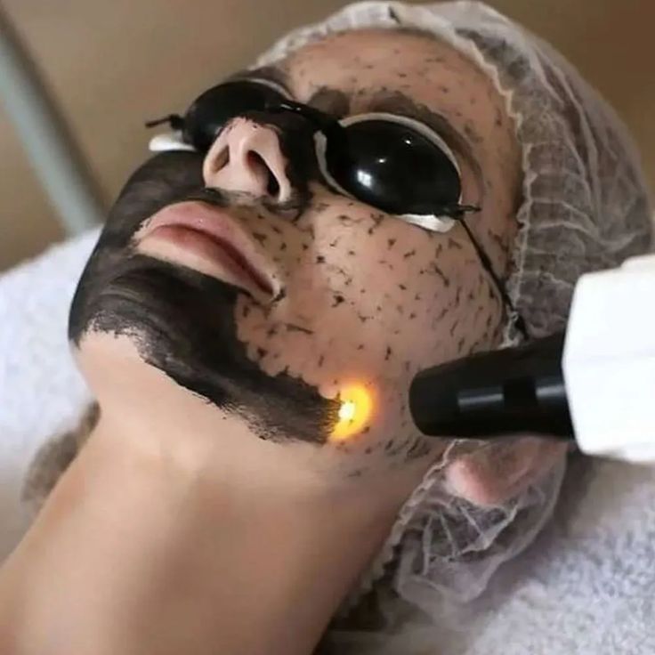carbon-laser facial