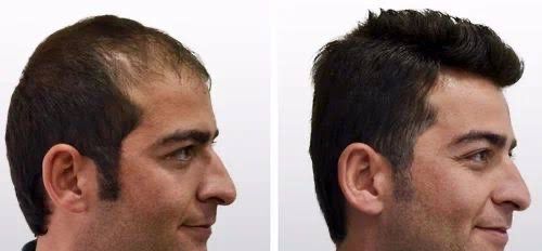 Hair Transplant